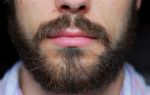 Алопеция на бороде у мужчин: причины, лечение, диагностика