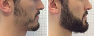 Наращивание бороды: хирургия или домашние средства?