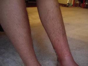 Почему выпадают волосы на ногах у мужчин: причины и лечение