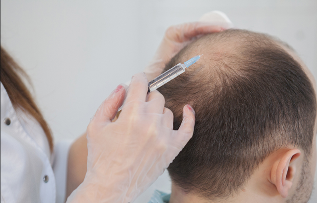 Сильно выпадают волосы: причины резкого облысения у мужчин