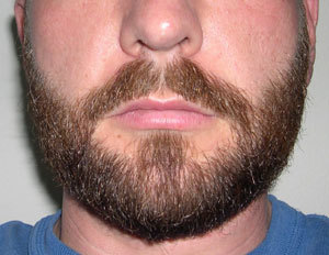 Не растет борода на щеках: почему и что делать?