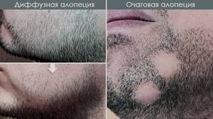 Некрасивые бороды: причины и фото