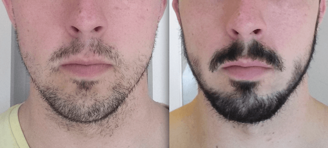 Миноксидил для бороды: помогает ли и как применять?