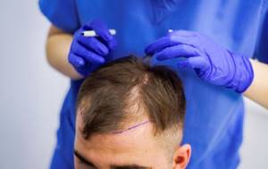 Методы лечения облысения у мужчин: как остановить выпадение волос и заставить их расти?