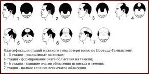 Методы лечения облысения у мужчин: как остановить выпадение волос и заставить их расти?