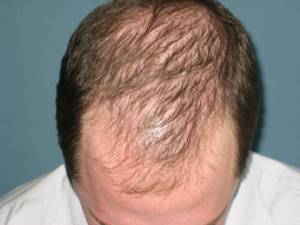 Диффузная алопеция: выпадение волос у мужчин