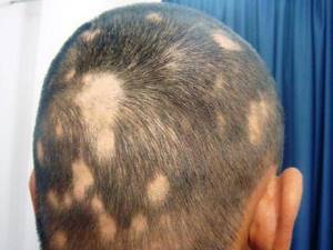Можно ли восстановить волосы после облысения у мужчин?