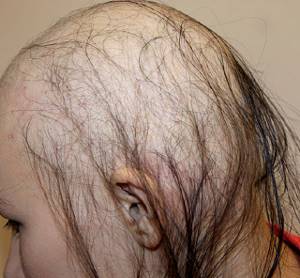Диффузная алопеция: выпадение волос у мужчин