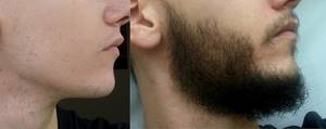 Как ускорить рост бороды в домашних условиях?