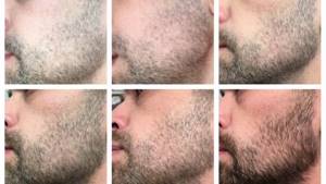 Миноксидил для бороды: помогает ли и как применять?